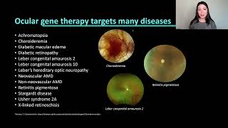 Lecture The Clinical amp Surgical Considerations of Gene Therapy in Retina Patients [upl. by Zurkow]