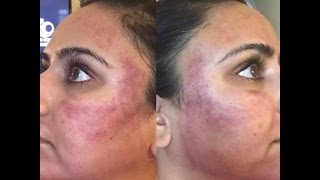 Acne Scar Resurfacing  Collagen Induction TherapyMedical Grade Microneedling  VLOG amp My Story [upl. by Ecnahc]