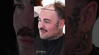 Hair Transplant Turkey hairtrasnplantturkey hairtransplant nowhairtime [upl. by Hellman822]