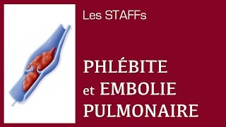 Phlébite et Embolie pulmonaire  12  STAFFs Saint Camille [upl. by Shirberg]