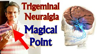 Acupressure Points For TRIGEMINAL NEURALGIA Acupressure For Trigeminal Neuralgia MADE EASY  HINDI [upl. by Gun]