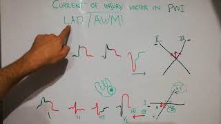 CVS 43  Current of injury  posterior wall myocardial infarction PWMI  How to interpret EKGs [upl. by Yehs699]