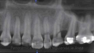 Tomografía de fracturas dentales  RXORAL 3D [upl. by Judus]