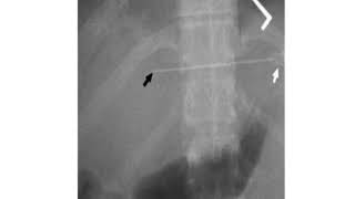 PTC PERCUTANEOUS TRANSHEPATIC CHOLANGIOGRAPHY [upl. by Lanford]