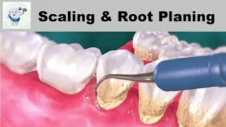 Dental Scaling and Root Planing  Treatment of Gum Disease [upl. by Kore]