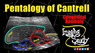 Pentalogy of Cantrell  Gastroschisis  Ectopia Cordis  Ultrasound  Anomaly  Case 289 [upl. by Angell]