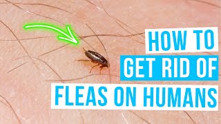 How to GET RID OF FLEAS ON HUMANS [upl. by Eylrac604]