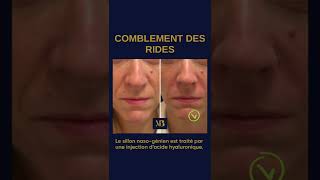 Comblement des rides du visage  sillon nasogénien par médecine esthétique acide hyaluronique [upl. by Annav]