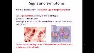 Streptococcus pneumoniae infection and disease [upl. by Jeanna]