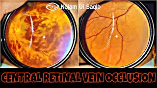 Central Retinal Vein Occlusion CRVO [upl. by Esau389]