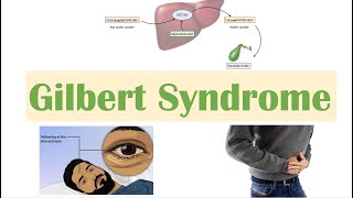 Gilbert Syndrome  Causes Genetics Pathogenesis Signs amp Symptoms Diagnosis Treatment [upl. by Sternlight306]