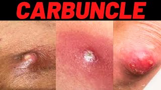 What is Carbuncle Carbuncle Definition Symptoms Causes Treatment USMLE [upl. by Atteyram284]