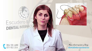 Periodontitis tratamiento · Dental Internacional [upl. by Nereus]