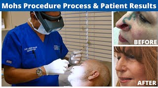 Mohs Surgery Procedure Explained From Start to Finish  Skin Cancer Treatment [upl. by Wain]