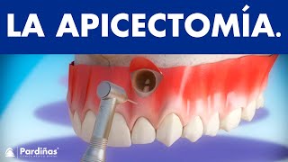 Apicectomía  Tratamiento infección de la raíz del diente © [upl. by Rhys]