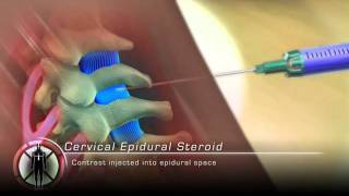 Cervical Epidural Steroid Injection Procedure Animation [upl. by Arriet]