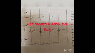 ECG 6ème partie HVG selon l indice de Sokolow [upl. by Meyeroff]