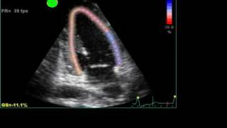 ABNORMAL STRAIN LONGITUDINAL ECHO [upl. by Roxanne]