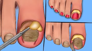 ASMR Cleanly Treat Old Ingrown Toenailsand Pus Toenails Scaling Animation Deep Clean Treatment [upl. by Gelman]