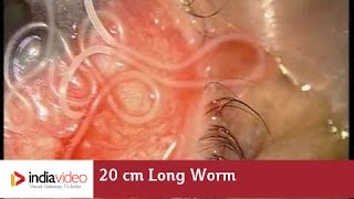 20 cm Long Worm In The Human Eye First Ever Recorded On Video  India Video [upl. by Cinamod]