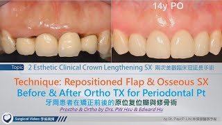 Esthetic Clinical Crown Lengthening Surgeries [upl. by Arreyt]