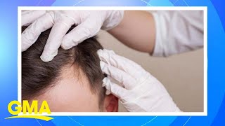 New study finds some natural hair loss remedies may work  GMA [upl. by Nylaehs737]