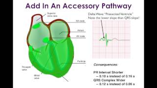 WolffParkinsonWhite WPW and Associated Arrhythmias [upl. by Ettenuj533]