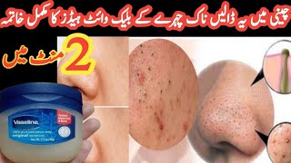 How To remove blackheads amp whiteheads from nose and face naturally at home [upl. by Carley]