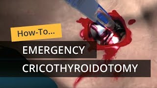 Emergency Cricothyroidotomy using CricKey [upl. by Esinaej]