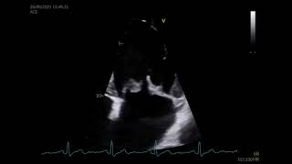 Myxomatous mitral valve on echo  ETT válvula mitral mixomatosa [upl. by Buonomo561]