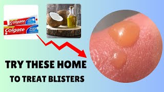 Want to Avoid Blisters Try These Home Remedies to Treat Burn Wound [upl. by Rider]