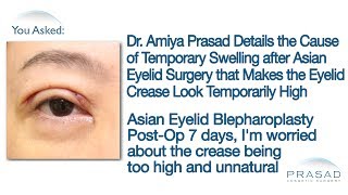 Why Temporary Swelling Concentrates in the Upper Eyelids after Asian Double Eyelid Surgery [upl. by Chellman204]