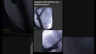 Intertrochanteric Fractures are common extracapsular fractures of the proximal femur fracture [upl. by Ninos]