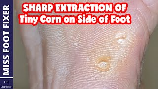 How To Remove TINY CORNS From Foot  Foot Side Tiny Corns Removal 2022  By Miss Foot Fixer [upl. by Kerekes372]