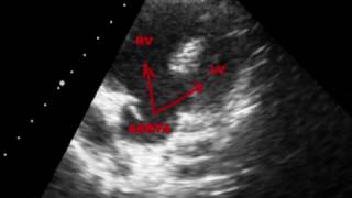 TETRALOGY OF FALLOT TOF  ECHOCARDIOGRAPHY SERIES BY DR ANKUR K CHAUDHARI [upl. by Donella797]