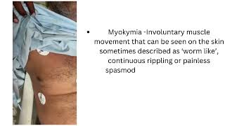 MYOKYMIA IN A CASE OF GUILLAIN BARRE SYNDROME [upl. by Euqram31]