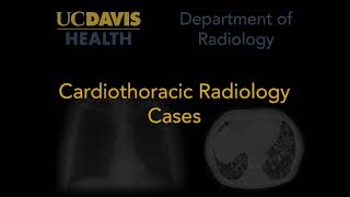 Complete left lower lobe atelectasis on chest radiograph [upl. by Ztnarf251]