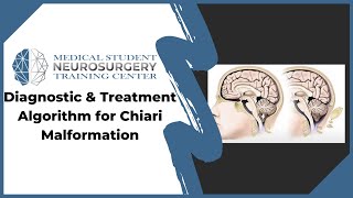 Diagnostic amp Treatment Algorithm for Chiari Malformation [upl. by Dnomder]