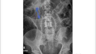 Small bowel obstruction [upl. by Ahsiemak]