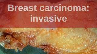 Breast Carcinoma Invasive  Pathology mini tutorial [upl. by Schlosser354]