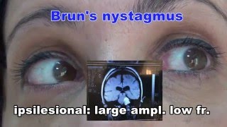 Bruns nystagmus [upl. by Cloris]