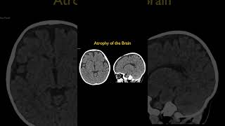 Atrophy of the Brain [upl. by Kobylak960]