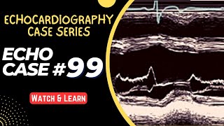 ECHO CASE 99  Echocardiography for Beginners  M Mode Echocardiogram [upl. by Woodberry18]