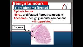 Neoplasia Benign Tumors [upl. by Earised]