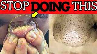 Dermatologist Explains Common Mistakes Why Youre Having Blackheads [upl. by Aeslehs530]