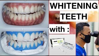 How to get the BEST results from teeth whitening kits [upl. by Gierk]