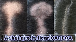 Alopecia Areata Produtos q Usei pra RECUPERAR MEU CABELO [upl. by Milson]