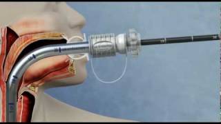 Food bolus retrieval using the GUARDUS™ Overtube and TALON™ Grasping Device [upl. by Mattson]