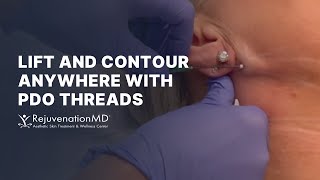 Using PDO Threads for a Neck Lift [upl. by Ynots]