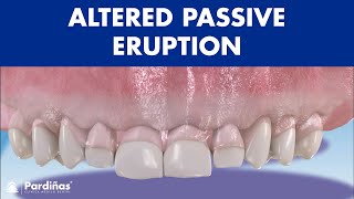 ALTERED PASSIVE ERUPTION and altered active  Consequences and treatments © [upl. by Teressa]